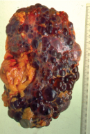 A photograph of an oval shaped kidney shows damage caused by polycystic kidney disease. The kidney appears swollen and misshapen. The surface on the top, bottom, and right side is covered with fluid-filled sacs that resemble kidney beans of different sizes. These fluid-filled sacs are the cysts, and they vary in color. Most of the cysts are reddish-brown, and some are grey. The left hand side contains an enlarged tan-colored mass that appears fatty with some blood vessels. Some small fatty areas and blood vessels also appear scattered throughout the kidney between the cysts. A ruler oriented vertically along the right hand side of the kidney shows that it measures approximately 200 millimeters from top to bottom.