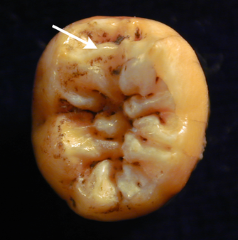 Lower first molar of a Neanderthal.